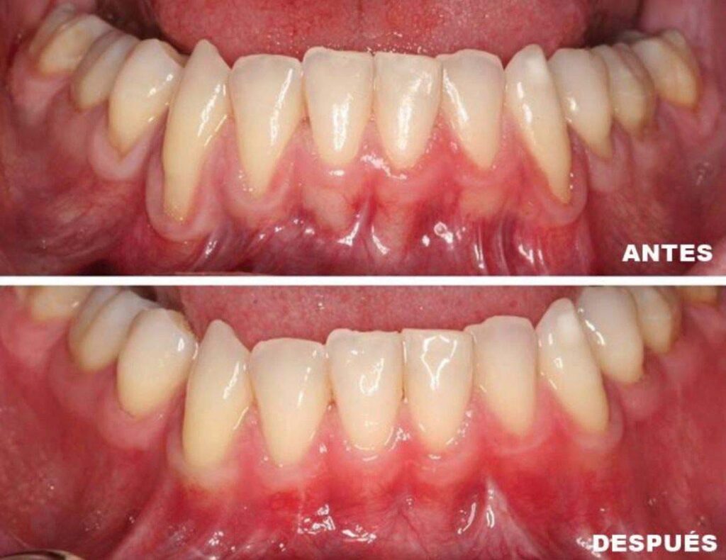 La importancia del diagnostico precoz en la periodontitis avanzada | Periodontitis avanzada como evitar la perdida de dientes y recuperar la salud de las encias 