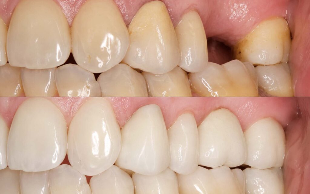antes y despues de ponerme implantes dentales | Tipos de implantes dentales cual es la mejor opcion para su salud oral 