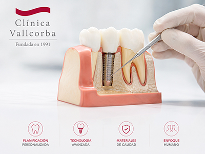 arcos implantes dentales en clinica dental de barcelona clinica vallcorba