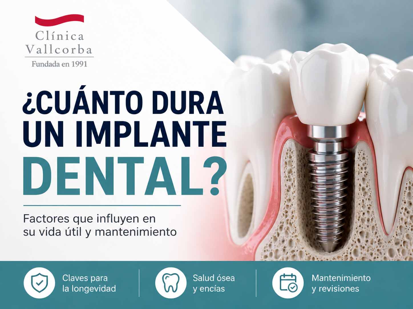 duracion implantes dentales | cuanto dura un implante dental