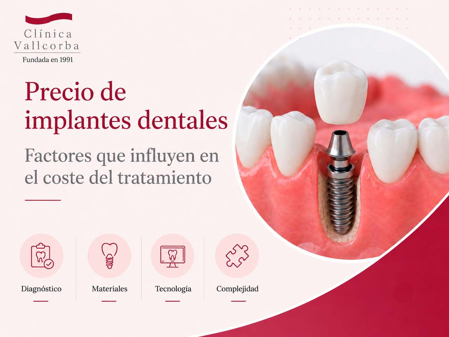 precio implantes dentales en barcelona | Implantes dentales precio y factores que influyen en el coste del tratamiento