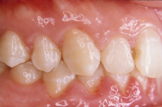 Señales y síntomas de la periodontitis