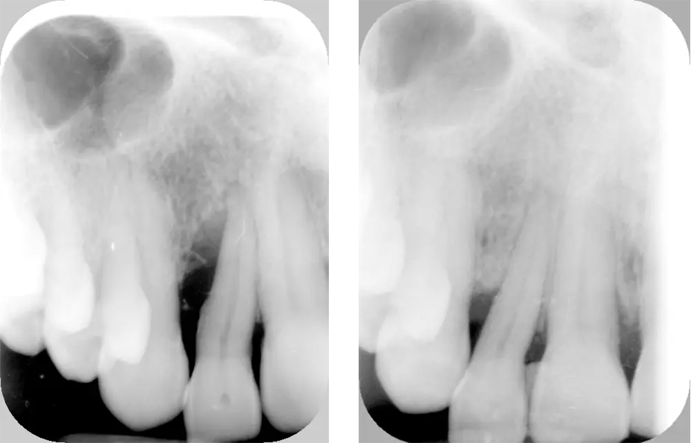 Tratamiento periodontal regenerativo