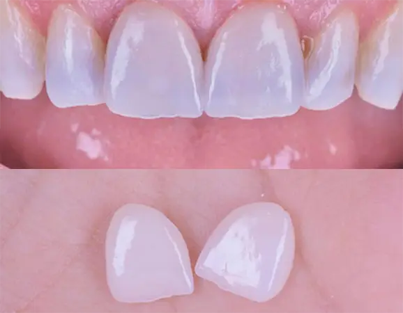 Carillas dentales - Clínica Vallcorba