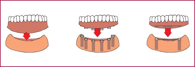 FAQS implantes dentales
