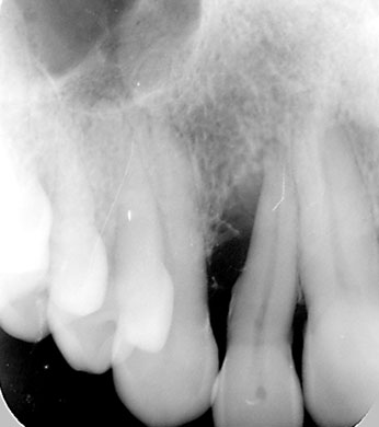 Tratamiento periodontal regenerativo
