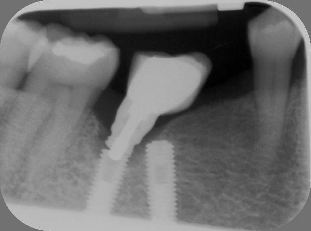 radiografía fractura dental