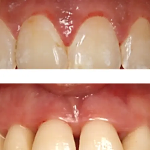 En que se diferencian las gingivitis y las periodontitis