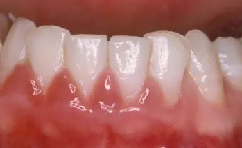 Tractament periodontitis