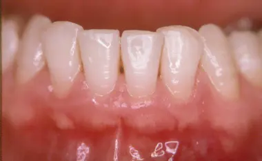 Tractament periodontitis