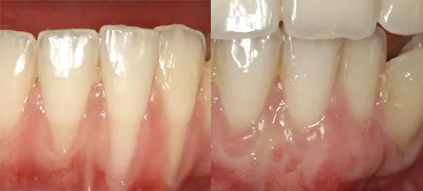 Injerto gingival en Clínica Vallcorba