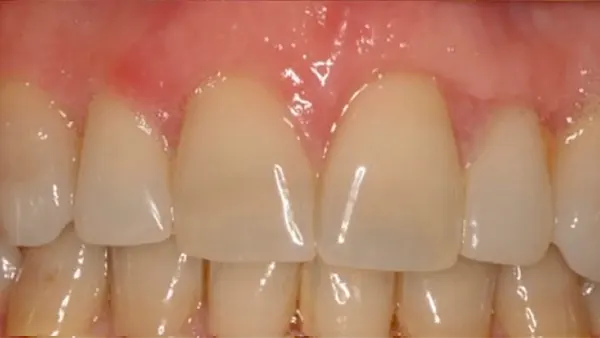 Injerto gingival, después