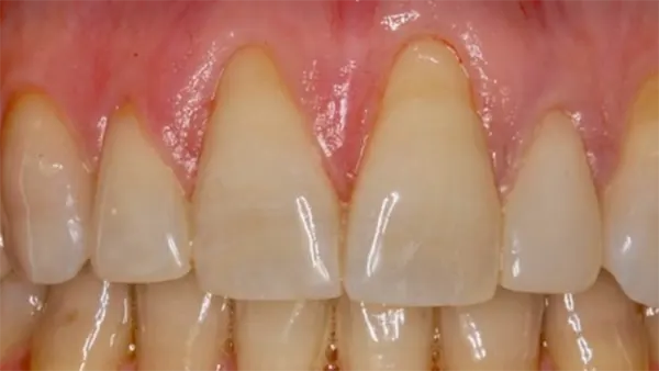 Injerto gingival previo