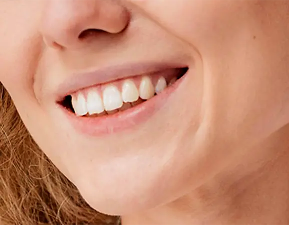 La importancia del control de los implantes dentales - Vallcorba
