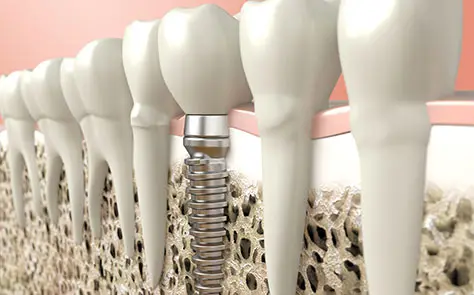 La importancia del control de los implantes dentales - Vallcorba