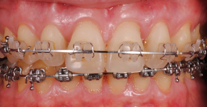 Se pueden realizar tratamientos de ortodoncia en pacientes que tienen problemas de encías