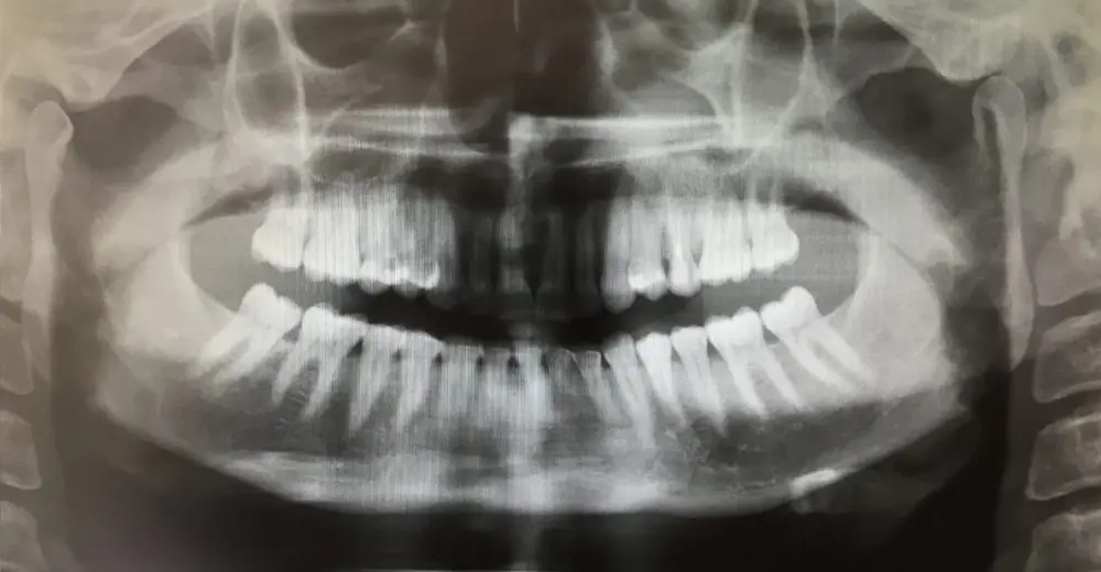 ¿Para qué realizamos radiografías los dentistas?