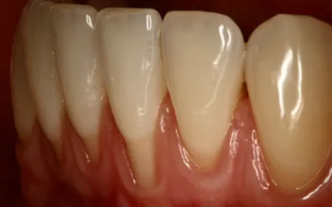 Recomendaciones para tratar pacientes con fenotipo periodontal fino (encía fina)
