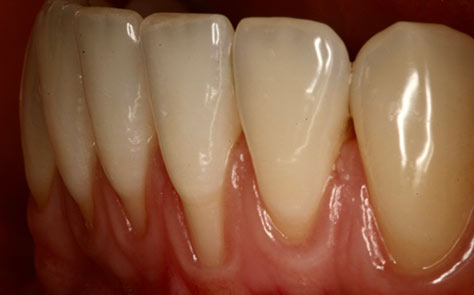 Recomendaciones para tratar pacientes con fenotipo periodontal fino (encía fina)